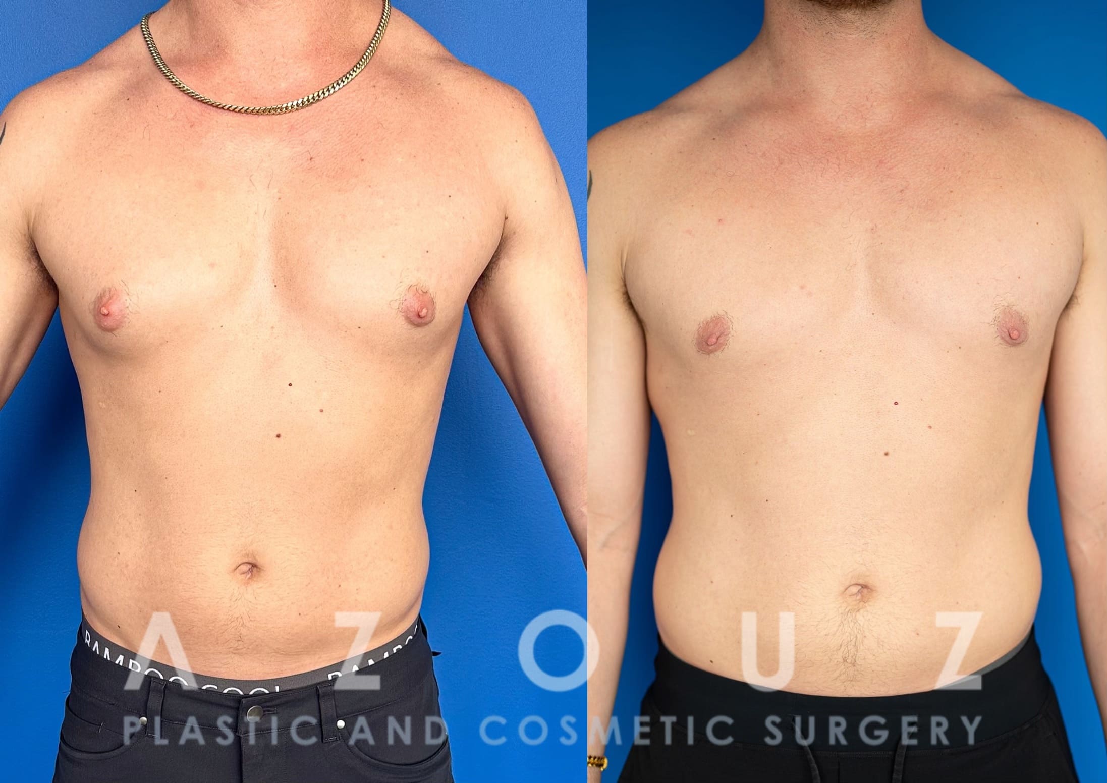 before and after male breast removal surgery by Dr. Solomon Azouz