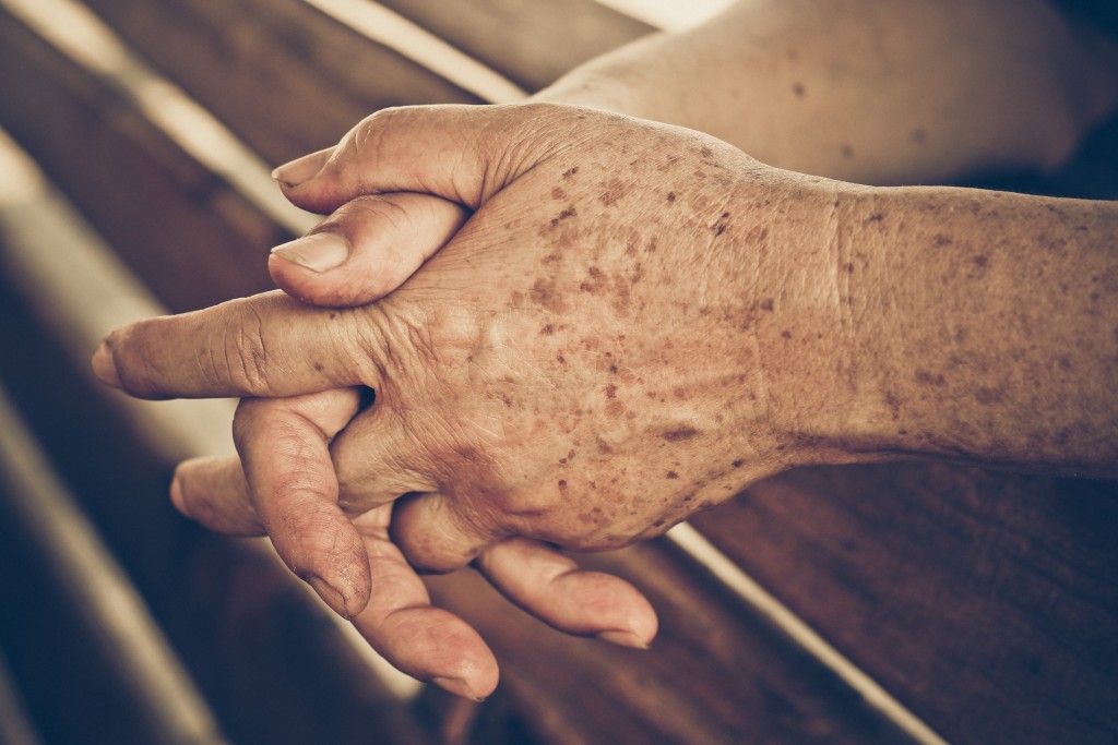 sun spots on hands