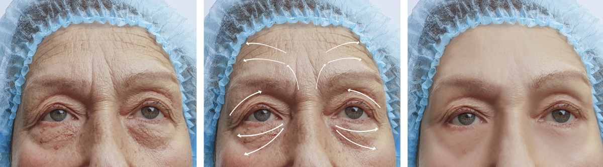 chemical peel eyelid lift before and after