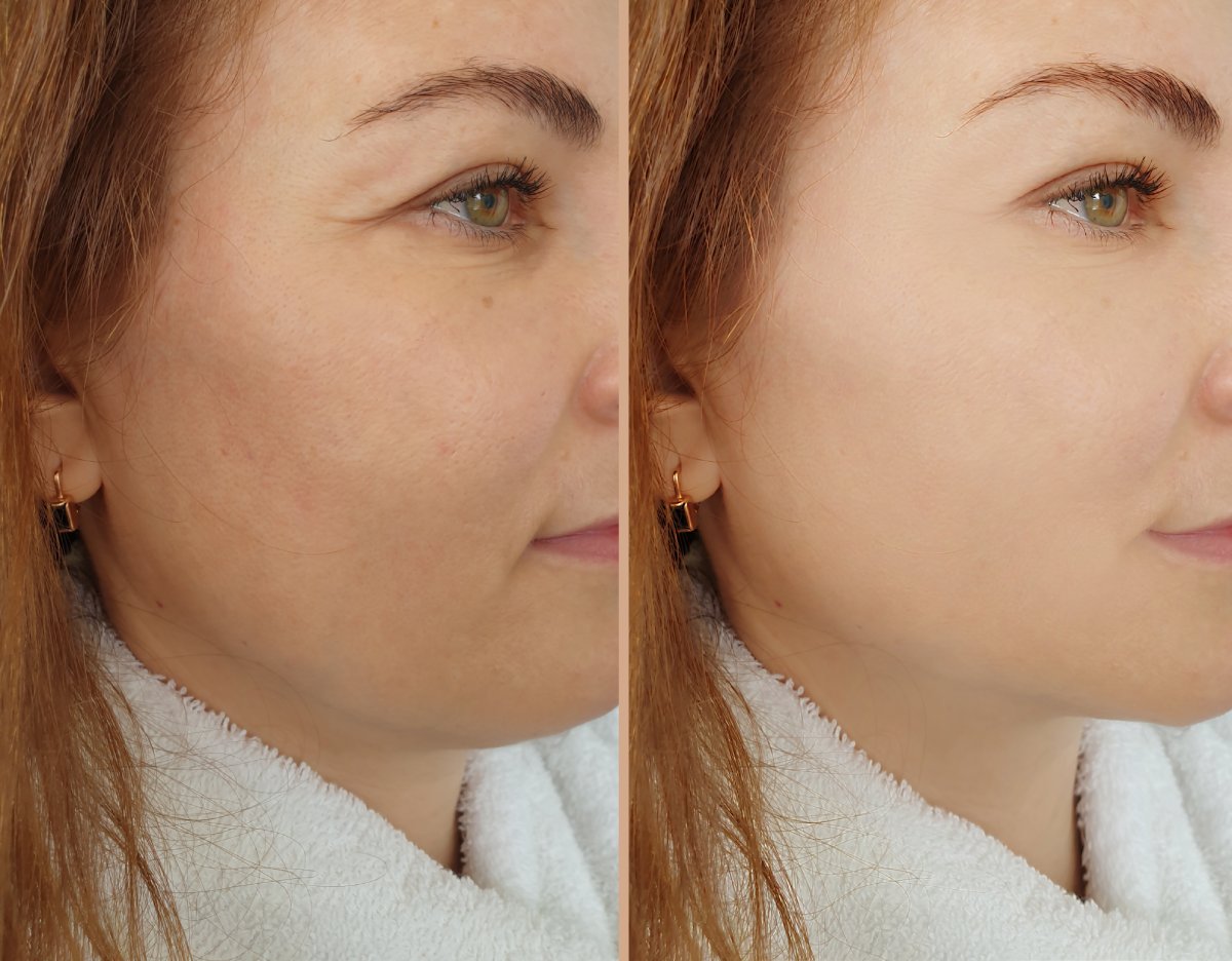 chemical peel before and after