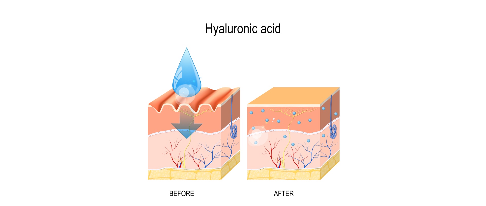 hyaluronic acid fillers