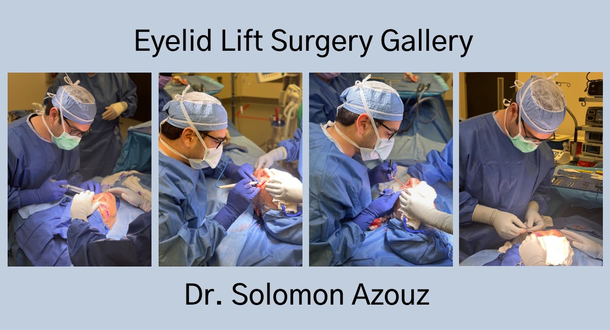 Dr. Solomon Azouz | Eyelid Lift Surgery Gallery