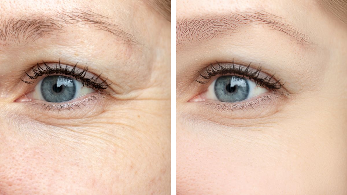 under eye filler before and after