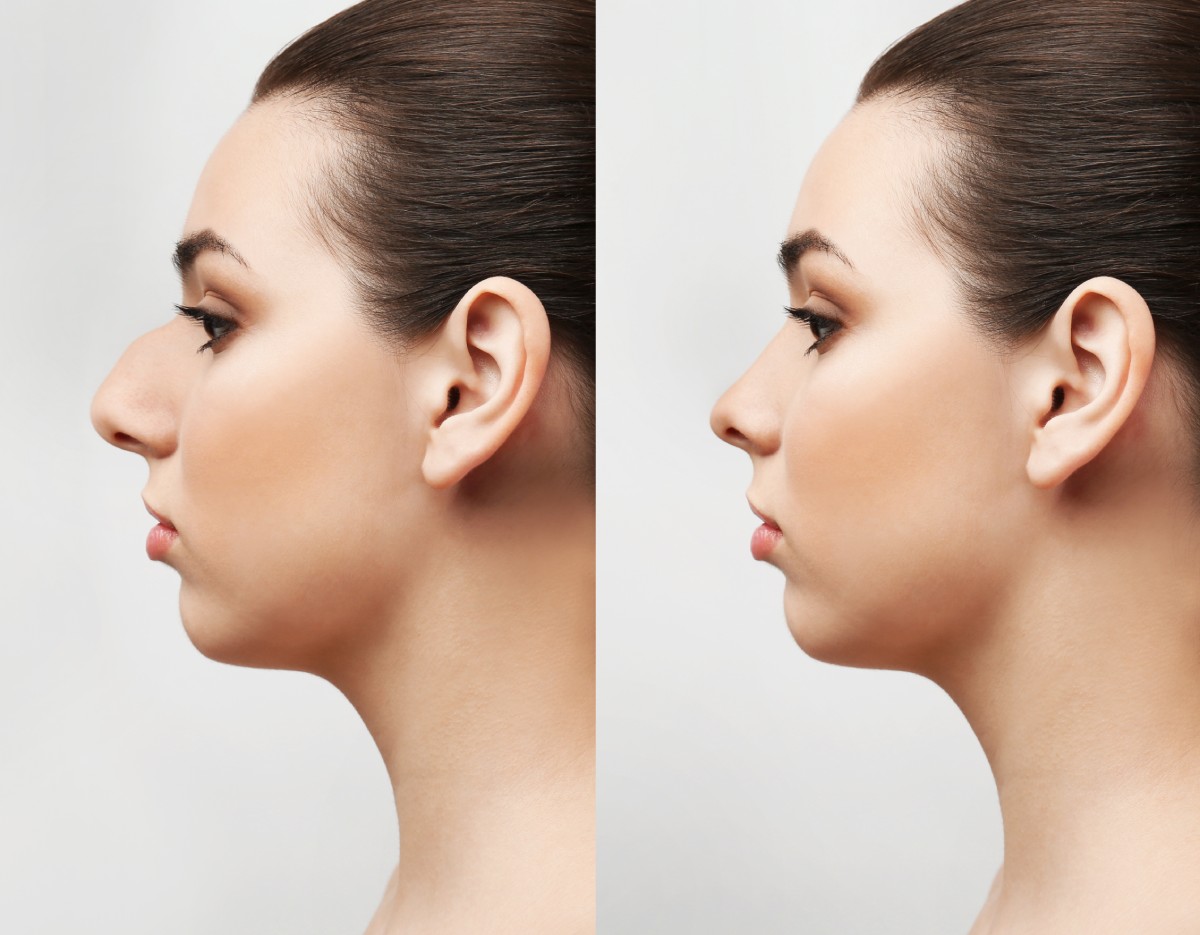 nose job before and after