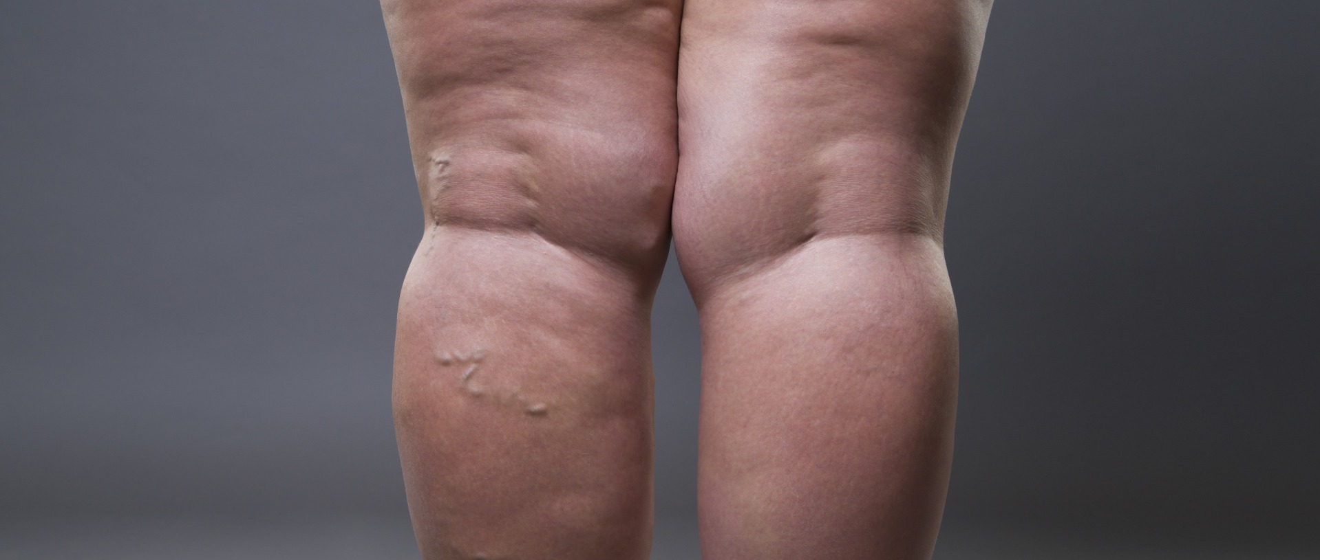 lipedema and cellulite