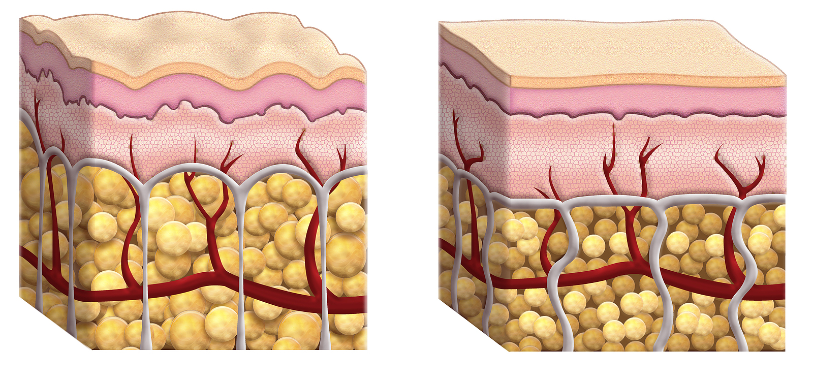 lipedema fat vs normal fat tissue