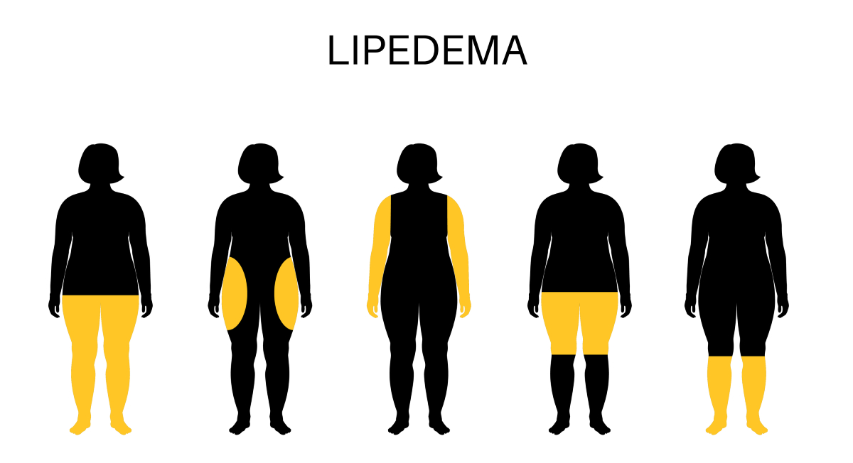 concepto de enfermedad de lipedema