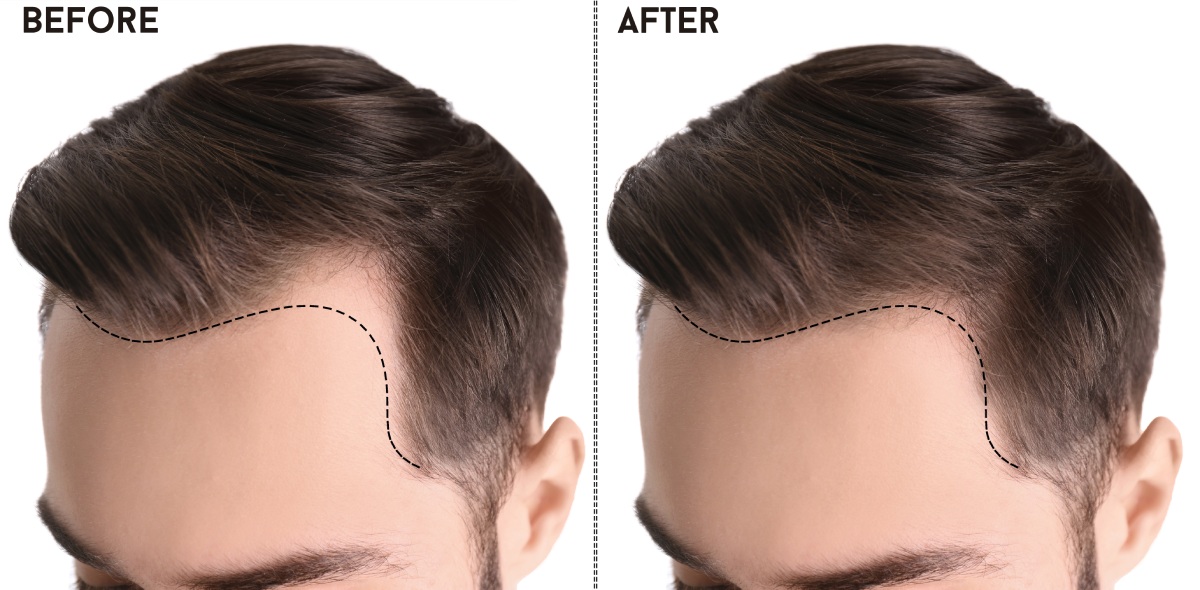 trasplante de cabello masculino antes y después